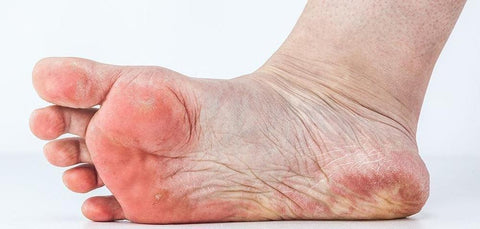 Fußpilz vorbeugen – mit der richtigen Fußpflege-Scholl DE